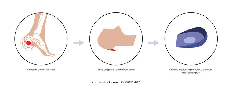 Concepto de insoles ortóticos. Molestias al caminar o correr. Fascitis plantar o talón estimulante tratamiento. Dolor de pies, lesión, hinchazón, inflamación dolorosa del pie aislado ilustración vectorial plana