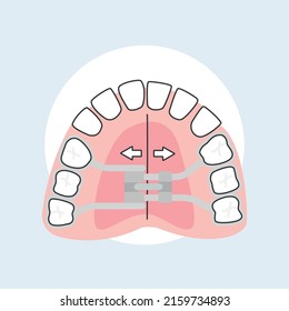 Ilustrador del vector ortodoncista Ortodoncia Interceptiva