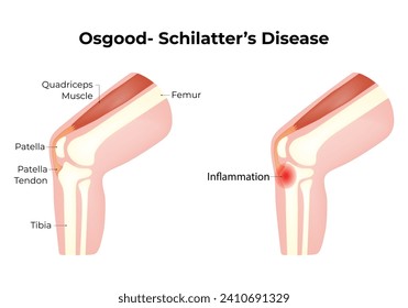 Osgood Schilatters Disease Science Design Vector Illustration