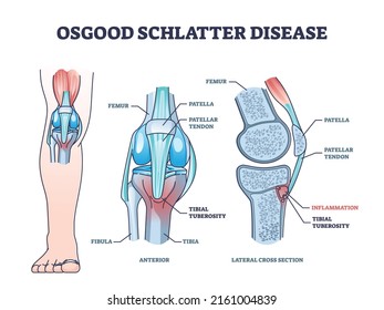 Osgood schlatter disease condition with leg and knee joint pain outline diagram. Labeled educational medical scheme with patella tendon inflammation and tibial tuberosity anatomy vector illustration.