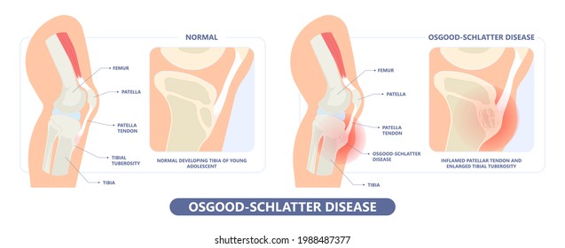 Osgood-Schlatter Disease knee injury Jumper’s Knee arthritis chondromalacia spurt puberty pull athletes joint osteochondritis dissecans injuries