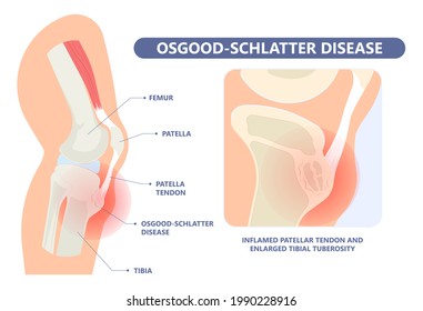 Verletzung der Patella durch Knochenbrüche des Knies