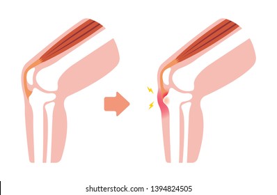 Osgood-schlatter disease (knee joint disease) illustration (no text)