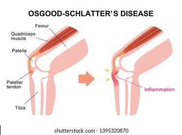 Osgood-schlatter disease (knee joint disease) illustration