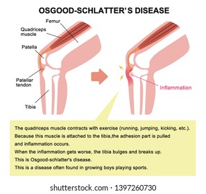 Osgood-schlatter disease (knee joint disease) illustration (with explanation text)