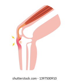 Osgood-schlatter disease (knee joint disease) illustration (no text)