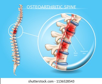 Osteoarthritic Spine Vector Medical Scheme with Magnification of Vertebral Column Area Affected by Disease, Pain Epicenter, Inflamed and Damaged with Bone Spur Narrowed Disk Realistic Illustration