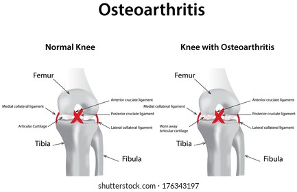 Osteoarthritis