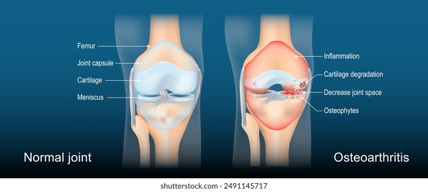 Osteoarthritis. Arthritis is degenerative joint disease. Realistic transparent blue joint on dark background. Poster with text label for medical education. vector illustration like X-ray image