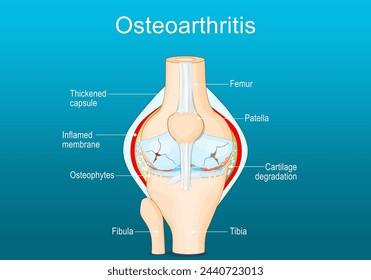 Osteoarthritis. Arthritis of a knee joint. Pain within a knee. Degenerative joint disease. Isometric Flat vector illustration