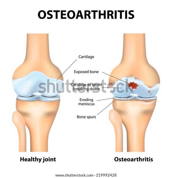 remediu articular artritic durere periodică în mușchi și articulații
