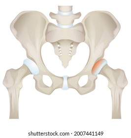 Osteoartritis - Muerte ósea - Articulación de cadera - Ilustración de acciones como archivo EPS 10