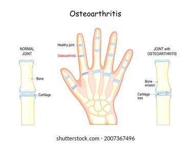 Osteoarthritis. Bones Of A Human Hand. Close-up Of Normal Joint Cartilage And Joint With Degenerative Disease