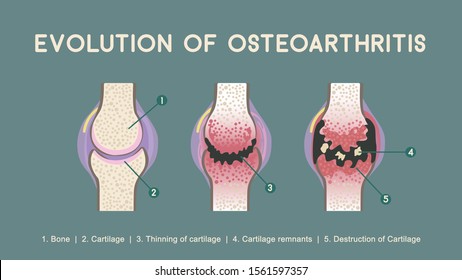 Osteoarthritis, Destruction Of Cartilage. Healthy Joint And Unhealthy Joint Anatomy. Osteoarthritis Medical Infographic Design.