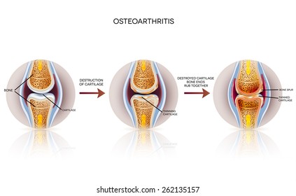 Osteoarthritis detailed illustration. From healthy joint to damaged joint, cartilage destruction.