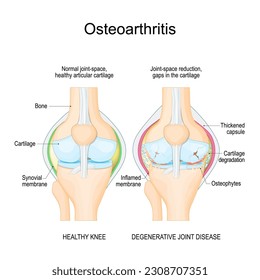 Osteoarthritis. Healthy knee join, and degenerative joint disease. Vector illustration