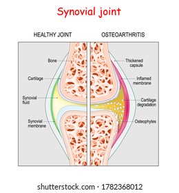 Osteoarthritis. Healthy Synovial joint and knee with Arthritis or pain. degenerative joint disease. Cartilage becomes worn. This results in inflammation, swelling, and pain