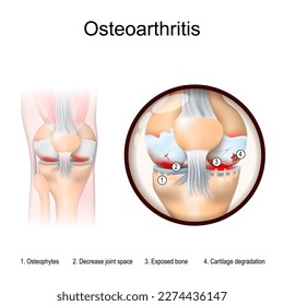 Osteoarthritis. Human leg with Inflammation of knee. Close-up of knee joint with  arthritis symptoms: Cartilage degradation, Exposed bone, Decrease joint space, and Osteophytes. Vector illustration