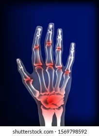 Osteoarthritis image sore inflammation joints bones the hand 