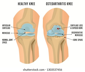 Osteoarthritis of the knee. Editable vector illustration in detailed realistic style isolated on a white background. Medical, healthcare and physiology concept. Scientific infographic.