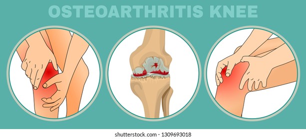 Osteoarthritis of the knee. Editable vector illustration in detailed realistic style isolated on a light green background. Medical, healthcare and physiology concept. Scientific infographic.