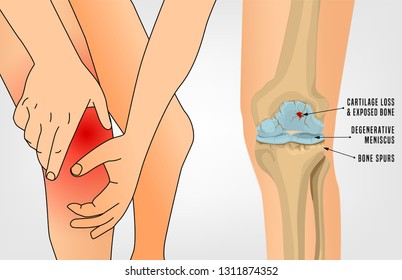 Osteoarthritis of the knee. Editable vector illustration in detailed realistic style isolated on a light background. Medical, healthcare and physiology concept. Scientific infographic.