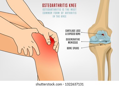 Osteoarthritis of the knee. Editable vector illustration in detailed realistic style isolated on a light background. Medical, healthcare and physiology concept. Scientific infographic.