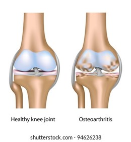 Osteoarthritis Of Knee Joint