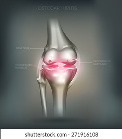 Osteoarthritis knee joint destruction detailed anatomy. Beautiful mesh abstract background