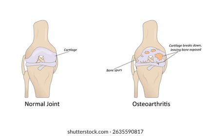 Osteoarthritis of the knee vector illustration