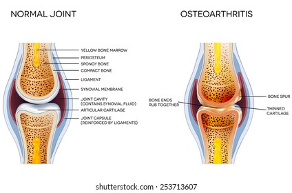 Osteoarthritis and normal joint anatomy