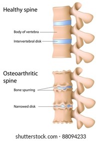 Osteoarthritis of the spine