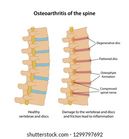 Osteoarthritis Of The Spine With Main Description. Healthy Spine And Spine With Osteoarthritis In Lateral View Are Isolated On White Background. Vector Illustration