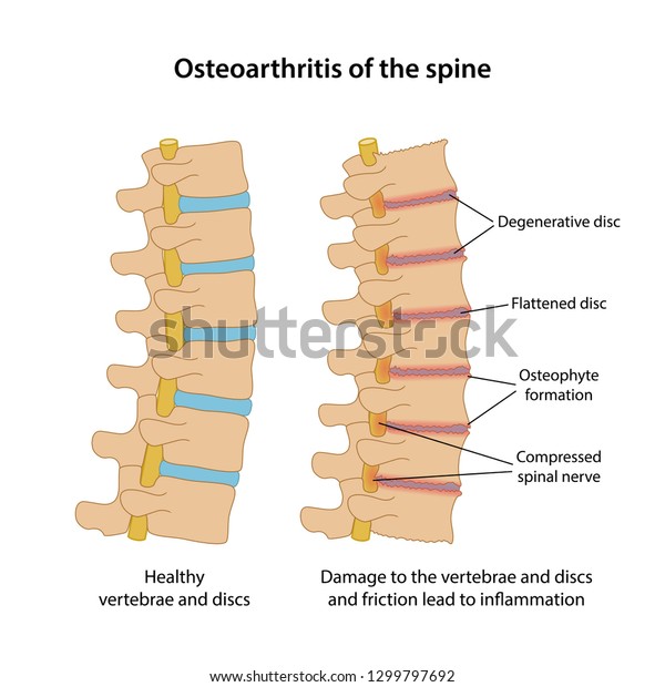 Osteoarthritis Der Wirbelsaule Mit Hauptbeschreibung Gesunde Stock Vektorgrafik Lizenzfrei