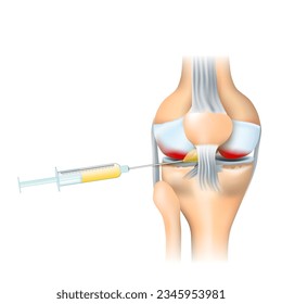 Osteoarthritis treatment. Syringe and Human knee joint with inflammation. PRP injection. therapy of joint pain. procedure of knee regeneration. Vector illustration