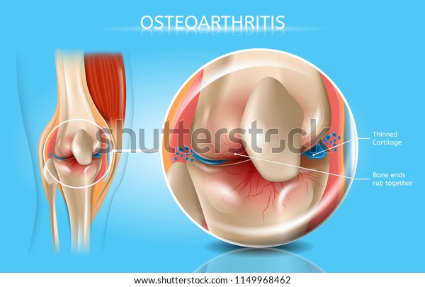 Osteoarthritis Vector Medical Poster with\
Magnification of Thinned Cartilage, Bone Ends Rub Together in\
Damaged Human Knee Joint Realistic Illustration. Musculoskeletal\
System Disease, Joints\
Injuries