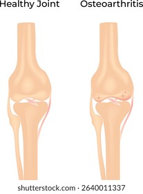 Osteoarthritis vs Healthy Knee Vector Illustration