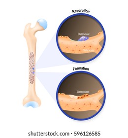 Osteoblast and osteoclast. The bone remodeling process. In a healthy body, osteoclasts and osteoblasts work together to maintain the balance between bone loss and bone formation.