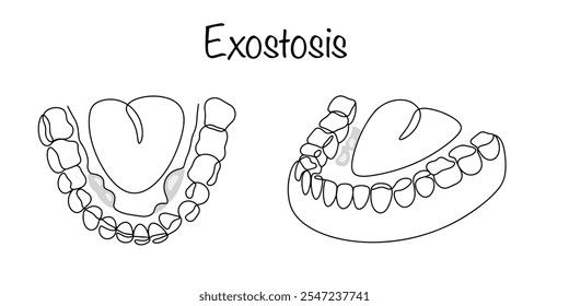 Uma formação osteocondral na forma de crescimento na parte óssea da mandíbula. Mandíbula inferior humana desenhada com exostose destacada. Ilustração de vetor médico.