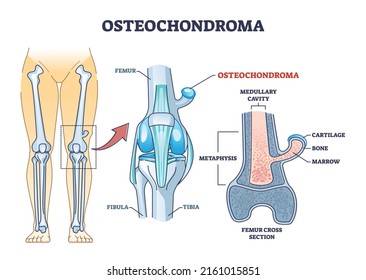 Osteochondroma knee problem as medical bone tumor overgrowth outline diagram. Labeled educational scheme with leg pathology explanation vector illustration. Femur cross section anatomical structure.