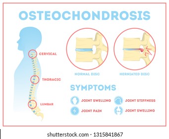 osteochondrosis neck)