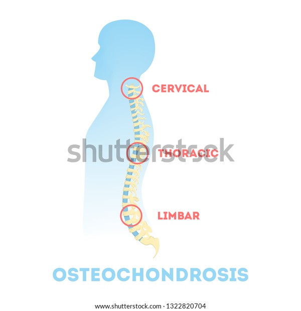 Osteochondrosis Anatomical Infographic Lumbar Cervical Thoracic Stock ...