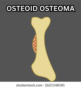 osteoid osteoma non cancerous bone tumor in long bone illustration useful for educational and healthcare industries orthopedics