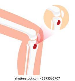 Osteomyelitis Disease Illustration for Medical