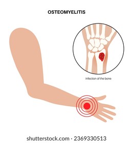 Enfermedad de osteomielitis. Hueso del brazo infectado, dolor y enrojecimiento superyacente. La infección se extiende a través del torrente sanguíneo hasta la muñeca. Bacterias de Staphylococcus aureus en la ilustración del vector corporal humano