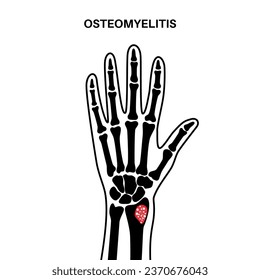 Osteomyelitis disease. Infected arm bones, pain and overlying redness. Infection spreads through the bloodstream into the wrist. Staphylococcus aureus bacteria in the human body vector illustration