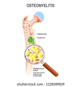 Osteomyelitis Clinical Practice