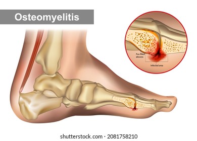 Osteomyelitis is an infection of bone. Diagram shows osteomyelitis of a humans foot bone.