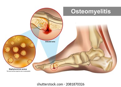 Osteomyelitis is an infection of bone. Staphylococcus aureus most common organism seen in osteomyelitis. Foot