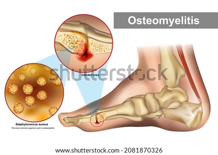 Osteomyelitis is an infection of bone. Staphylococcus aureus most common organism seen in osteomyelitis. Foot